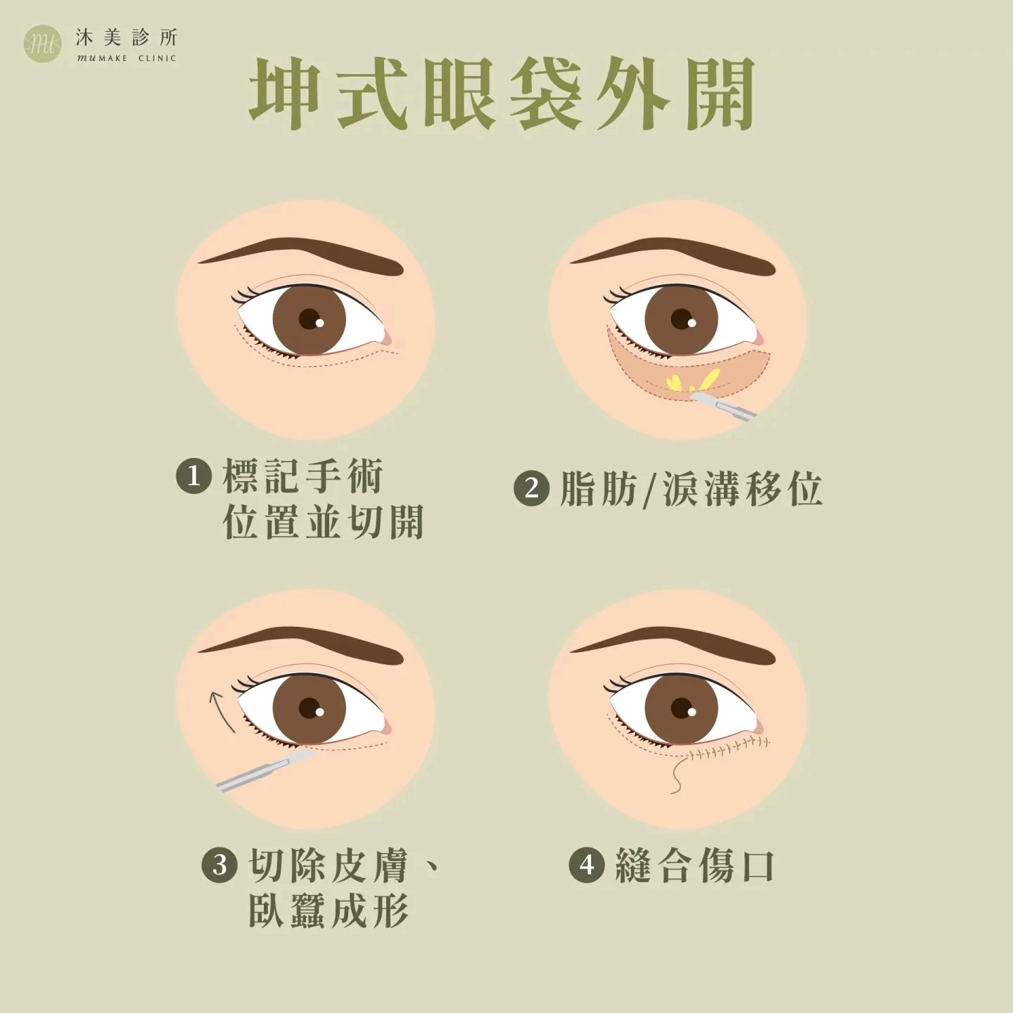 坤式眼袋外開