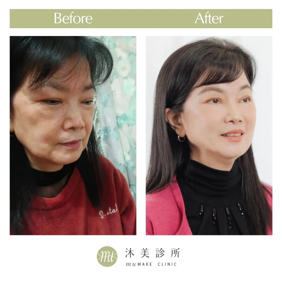 眼袋手術案例
