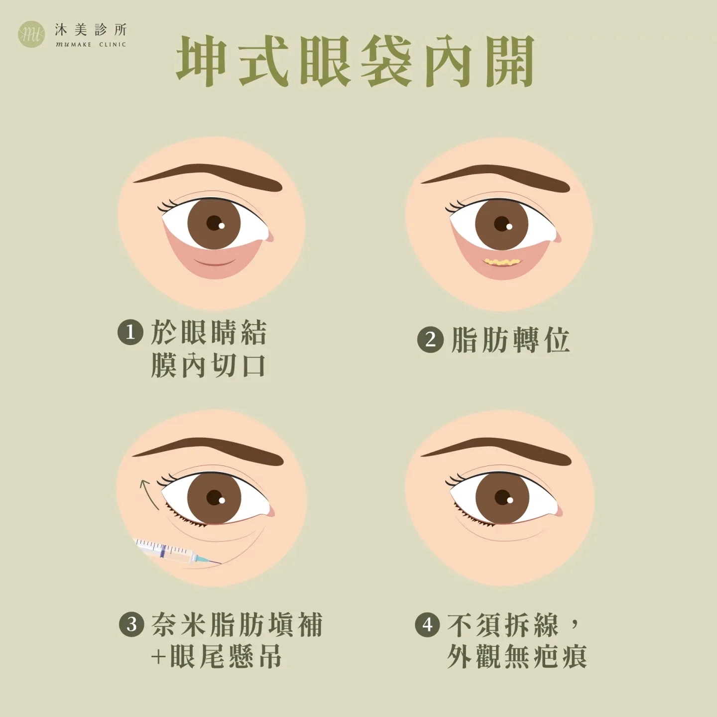 坤式眼袋內開