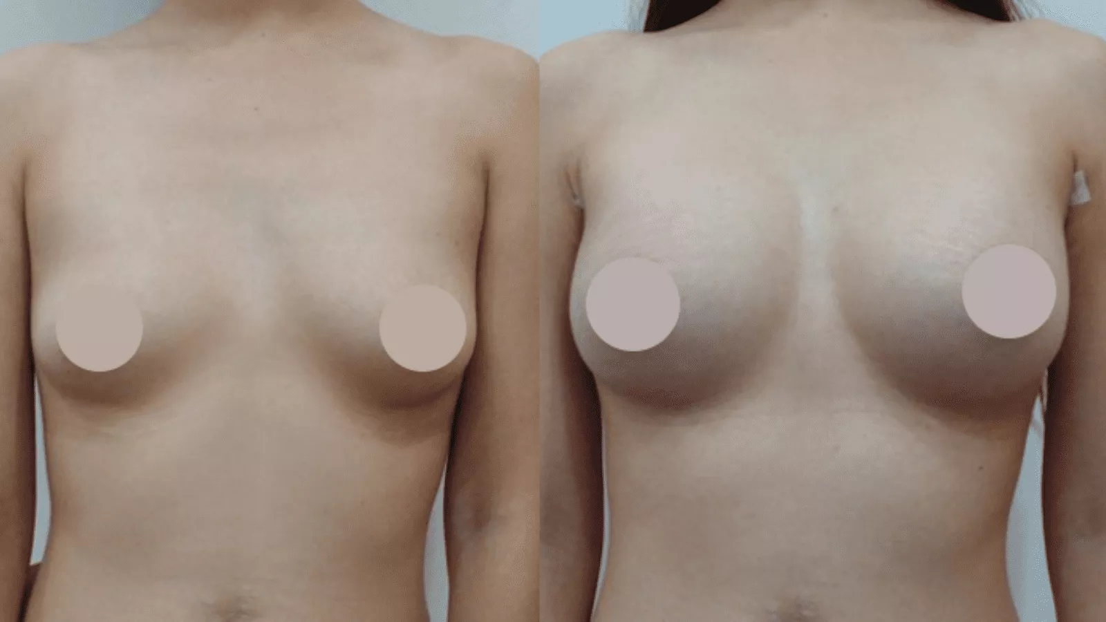 沐美隆乳手術費用透明，並擁有眾多手術成功案例