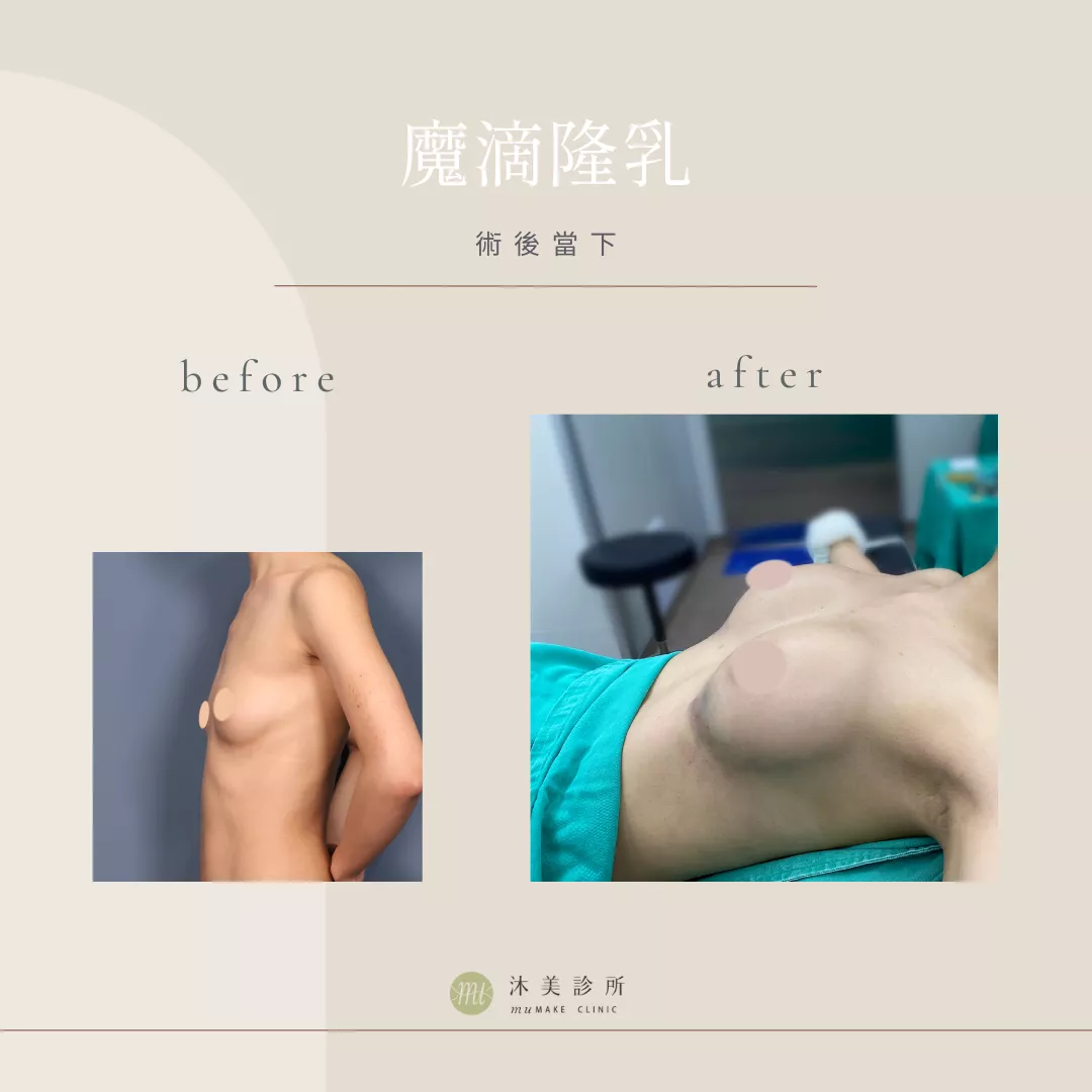 沐美魔滴隆乳成功案例，具體隆乳費用依照種類而有所不同