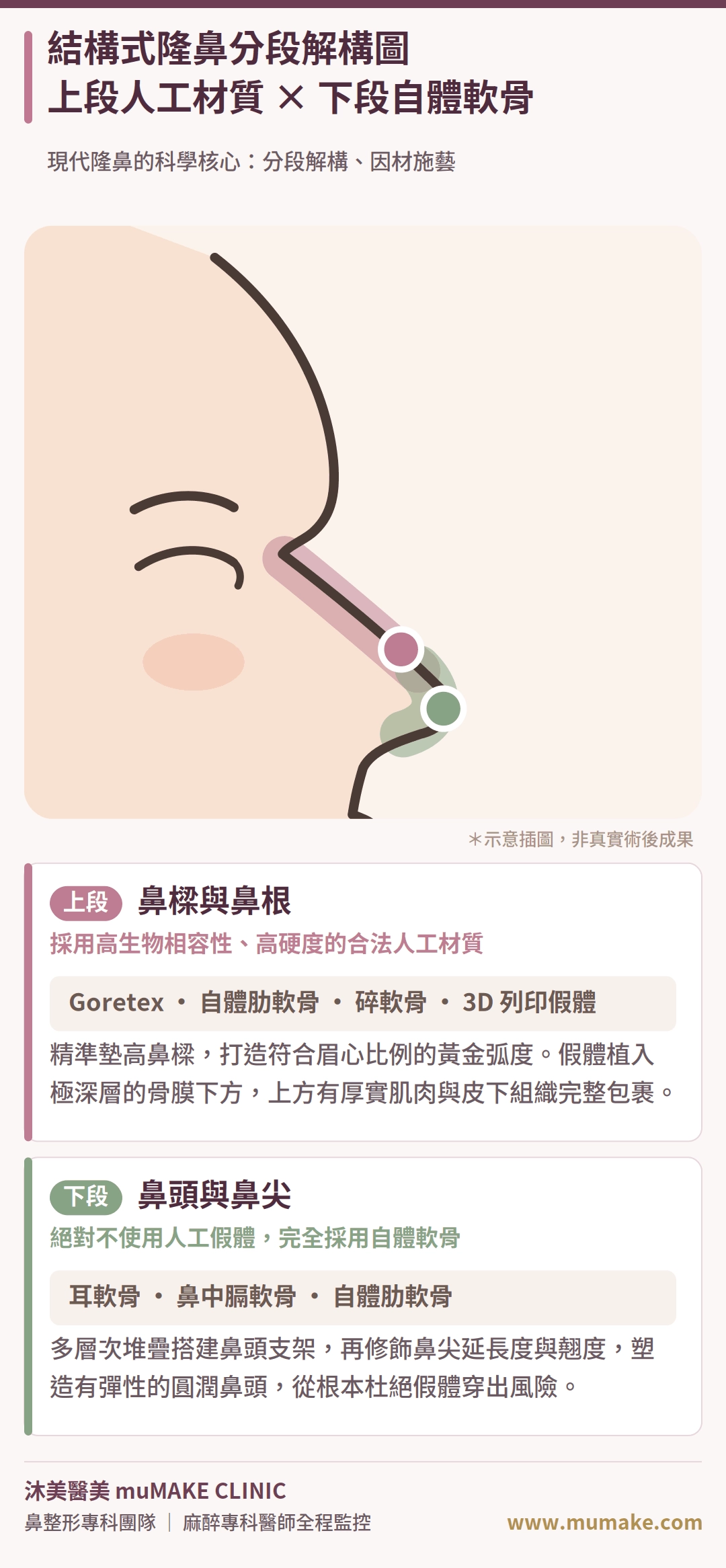 什麼是結構式隆鼻