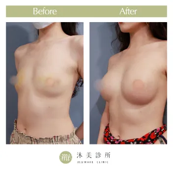 術後真實案例分享｜Before & After