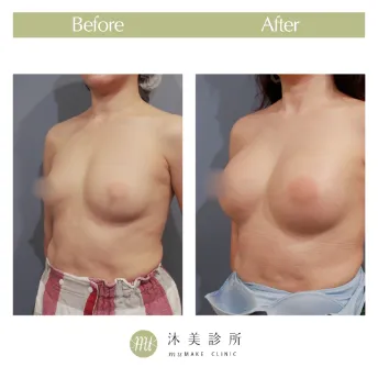 術後真實案例分享｜Before & After