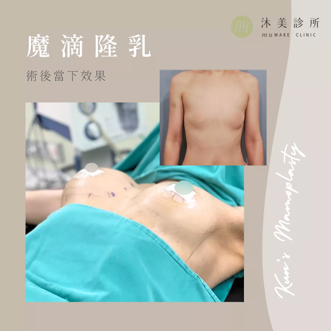 魔滴隆乳術後當下效果，具體隆乳價格需由醫師評估