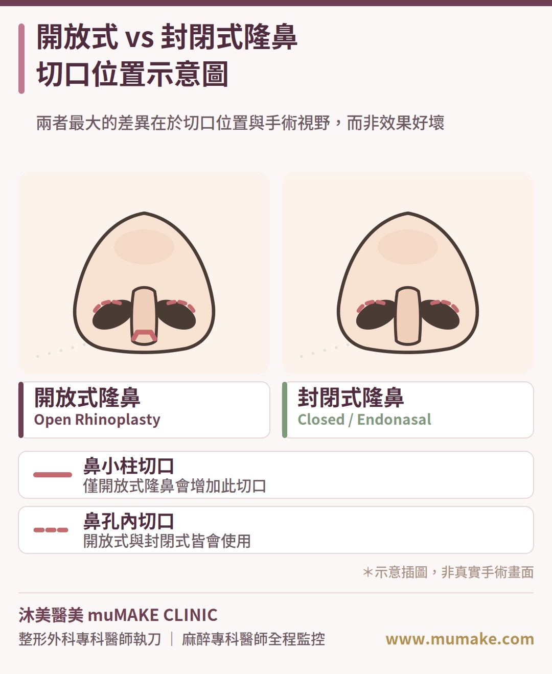 開放式隆鼻 vs 封閉式隆鼻切口示意圖