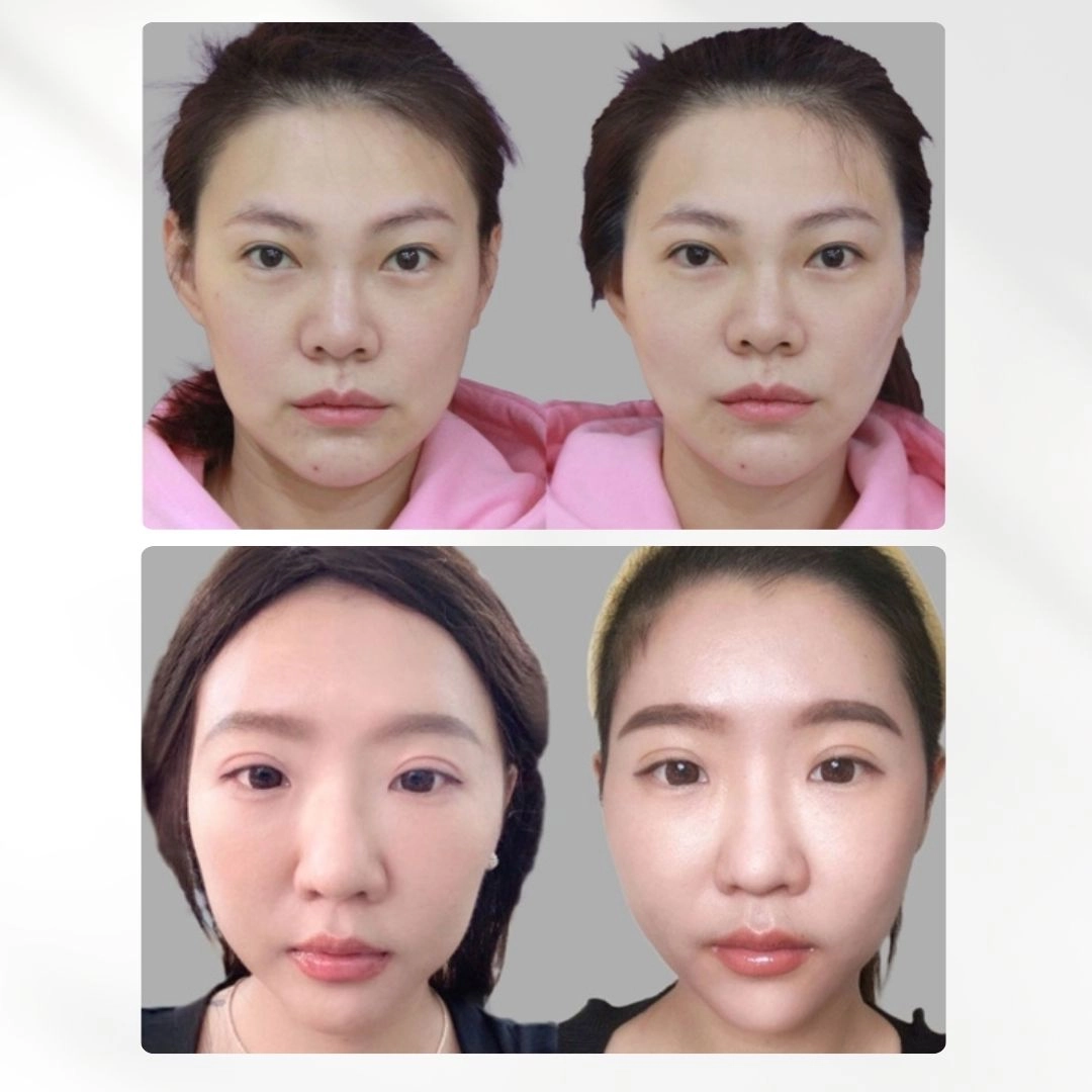 MINT Lift 秘特神力拉提線